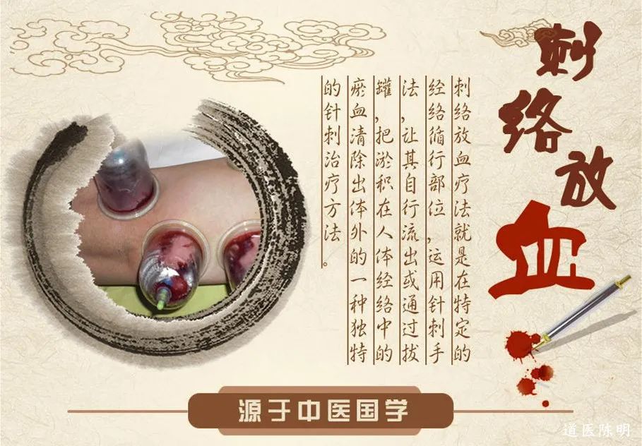 Bloodletting Therapy in Traditional Chinese Medicine: A Pathway to Healing