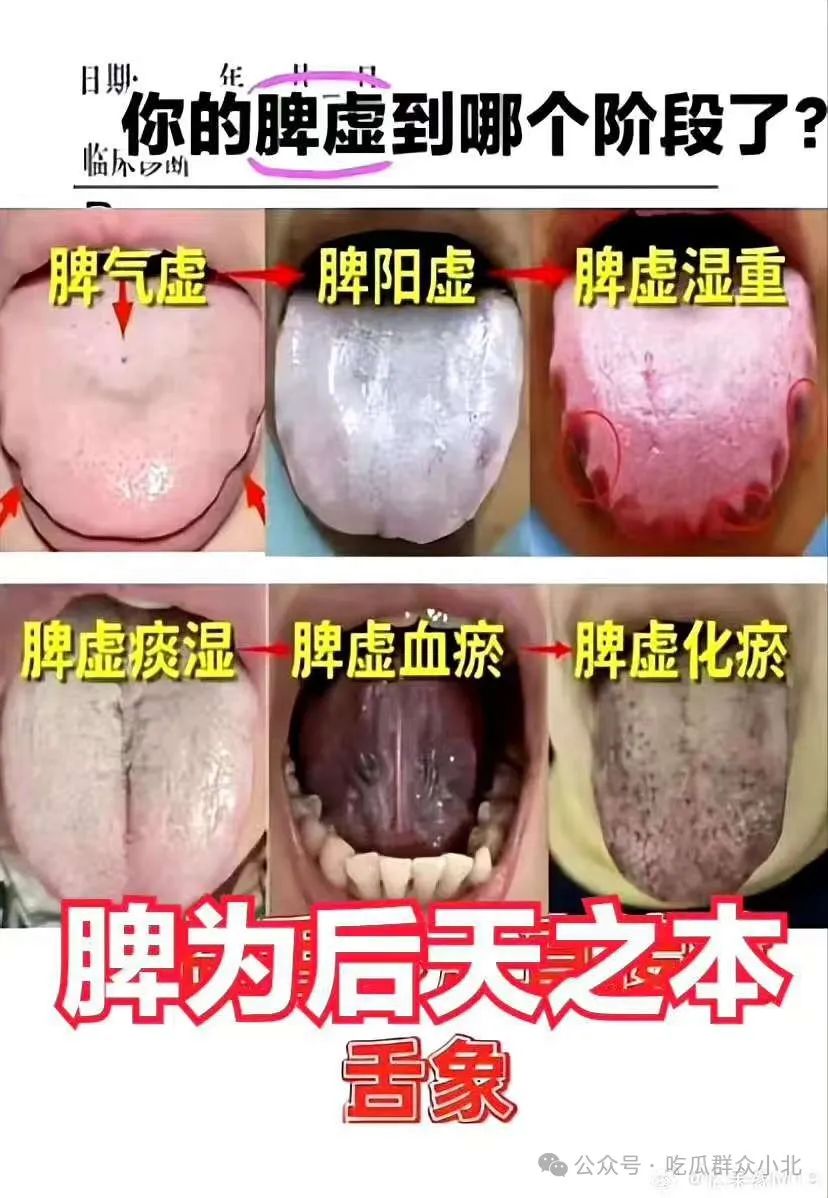 From Spleen Qi Deficiency to Blood Stasis: What Stage Does Your Tongue Indicate?
