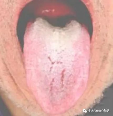 Tongue Diagnosis in Traditional Chinese Medicine: Tongue Coating