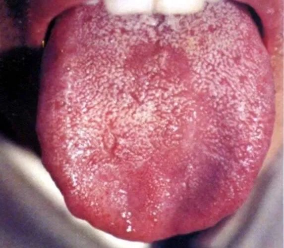 Observing Tongue Coating to Predict Diseases