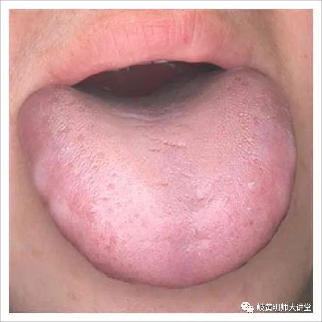Traditional Chinese Medicine Tongue Diagnosis: Illustrated Guide to 14 Types of Tongue Shapes and Qualities