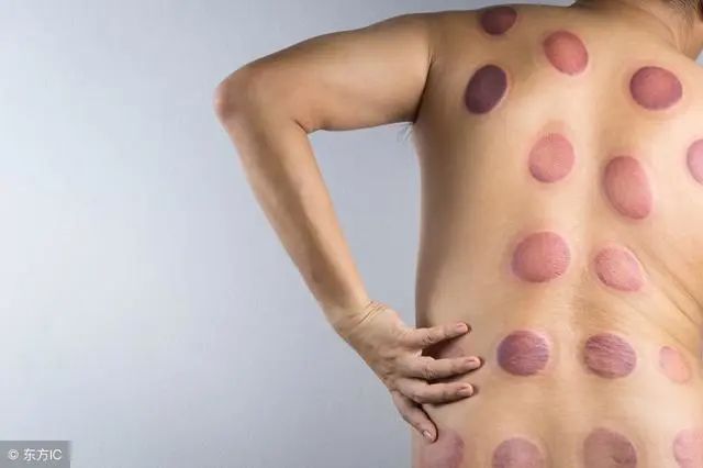 The Art of Cupping in Traditional Chinese Medicine: 5 Contraindications and Analysis of Cupping Marks