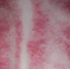Caution After Gua Sha: Risks of Blood Vessel Rupture and Precautions for Certain Individuals