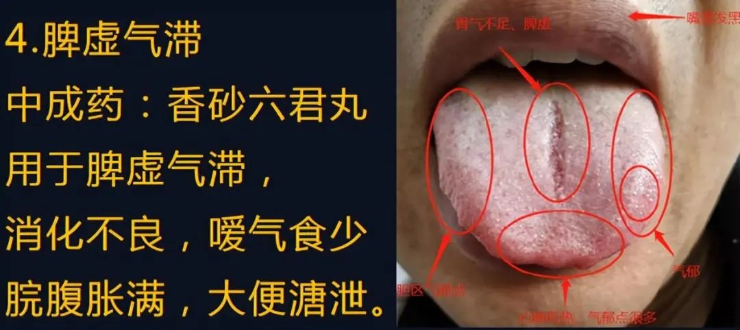Four Types of Spleen Qi Deficiency: Which One Are You?