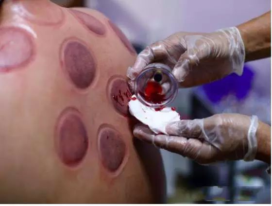 Is Phelps' Cupping a Victory for Traditional Chinese Medicine? Don't Be Overconfident