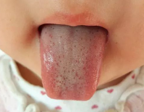 High-Definition Tongue Diagnosis Atlas for Children: Understanding Tongue Diagnosis (A Must-Collect)