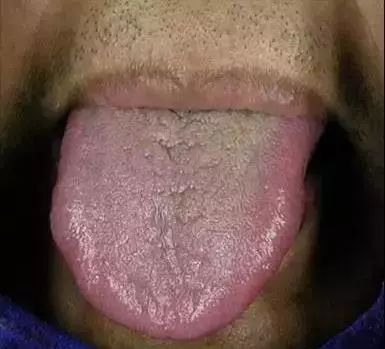The Most Comprehensive Guide to Tongue Diagnosis! Master It and Become a Tongue Diagnosis Expert