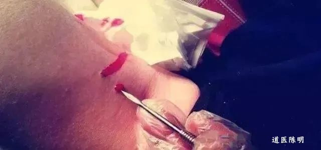 Bloodletting Therapy in Traditional Chinese Medicine: A Pathway to Healing