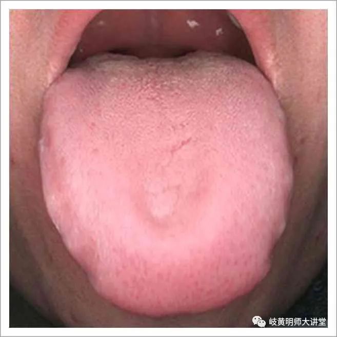 Traditional Chinese Medicine Tongue Diagnosis: Illustrated Guide to 14 Types of Tongue Shapes and Qualities
