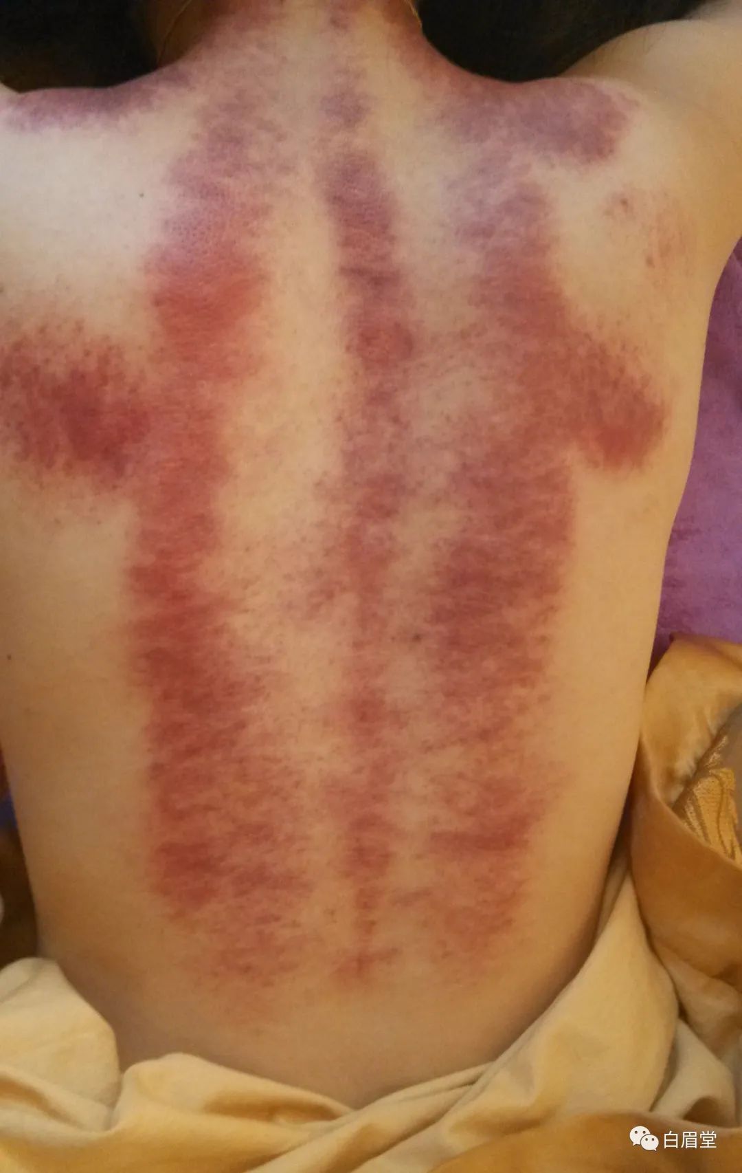 The Origins, Techniques, and Precautions of Gua Sha (Gua Sha: A Localized Method to Improve Circulation, Delay Aging, Promote Qi and Blood Flow, and Alleviate Pain)