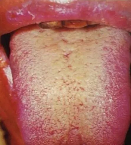 Comprehensive Guide to Tongue Diagnosis and Associated Conditions in TCM