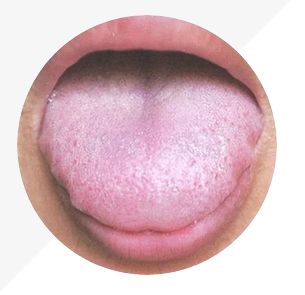 Understanding Tongue Diagnosis in TCM: Insights into Health from Tongue Appearance (Part 2)