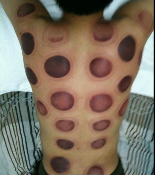 The Techniques and Diagnosis of Cupping and Sliding Cupping in Traditional Chinese Medicine