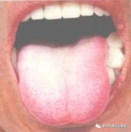 Tongue Diagnosis in Traditional Chinese Medicine: Tongue Coating