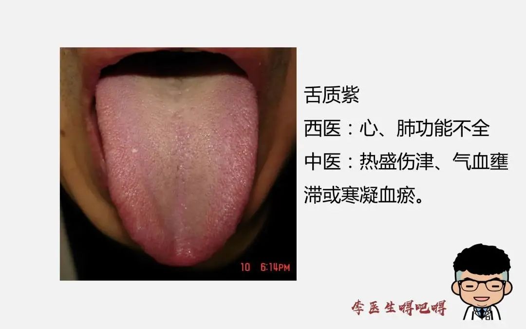 What Level of Tongue Diagnosis Does Western Medicine Have? Part 2: Tongue Quality and Coating