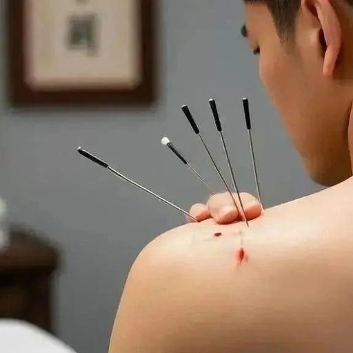 Cupping Therapy for Sciatica: Find the Right Acupoints for Easy Relief!