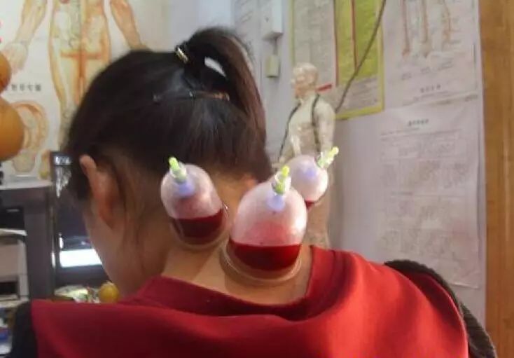 The Benefits of Bloodletting Therapy in Traditional Chinese Medicine