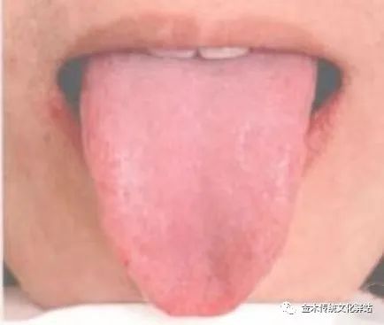 Tongue Diagnosis in Traditional Chinese Medicine: Tongue Coating