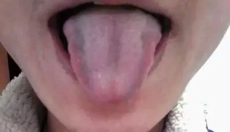 How to Observe Tongue Coating to Reflect Your Health