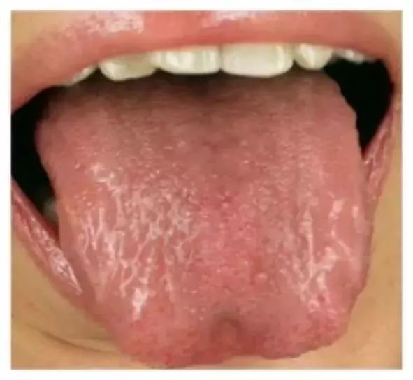 Understanding the State of Organs and Qi-Blood Dynamics Through Tongue Diagnosis