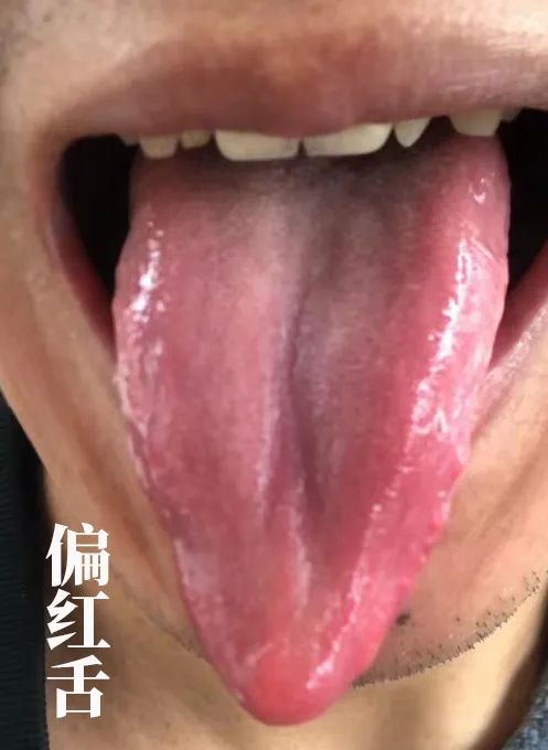 The Body Signals Illness: Understanding Tongue Diagnosis in TCM