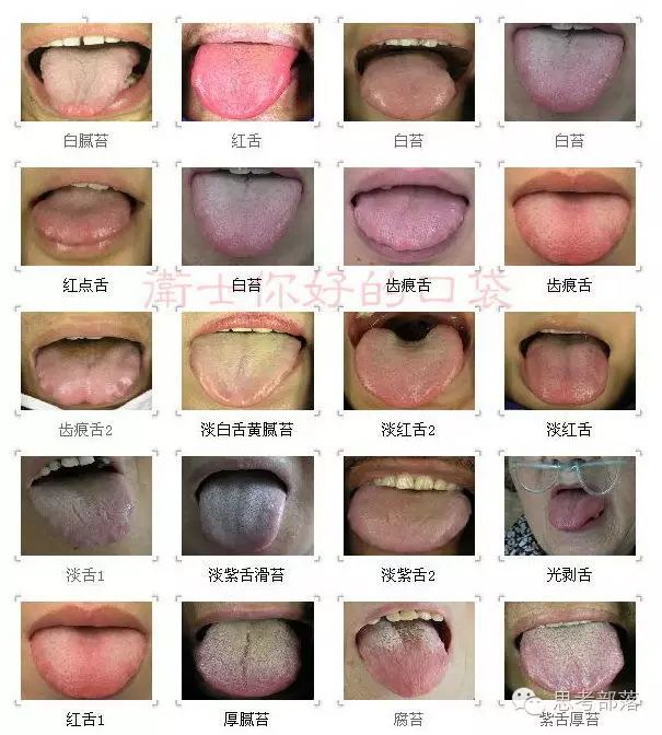 Comprehensive Guide to Tongue Diagnosis (8): 72 Types of Tongue Diagnosis Charts