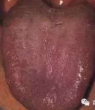 Understanding Tongue Diagnosis in Traditional Chinese Medicine (with Tongue Diagnosis Illustrations)