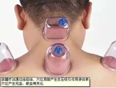 The Most Important Aspects of Cupping Therapy Revealed!