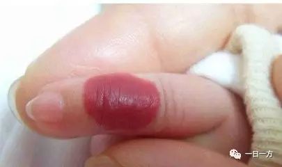 Two Powders for Hemangiomas