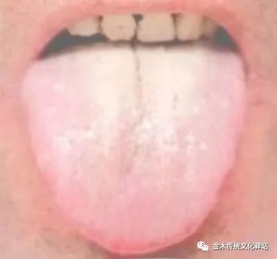 Tongue Diagnosis in Traditional Chinese Medicine: Characteristics of Tongue Coating
