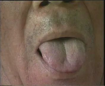 The Health Code Hidden on Your Tongue