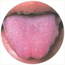 Observing Tongue Coating to Assess Health: A Summary of Classic Tongue Signs in Traditional Chinese Medicine