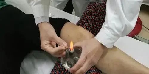 Acupuncture Department II: What Conditions Can Fire Needle Therapy Treat?