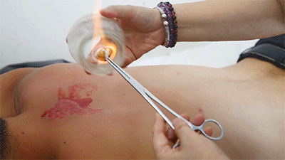 A Comprehensive Guide to Cupping Therapy