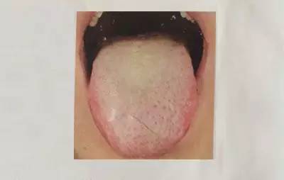 Exploring the Secrets of the Body Through Tongue Diagnosis