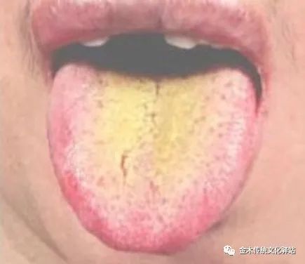 Tongue Diagnosis in Traditional Chinese Medicine: Tongue Coating