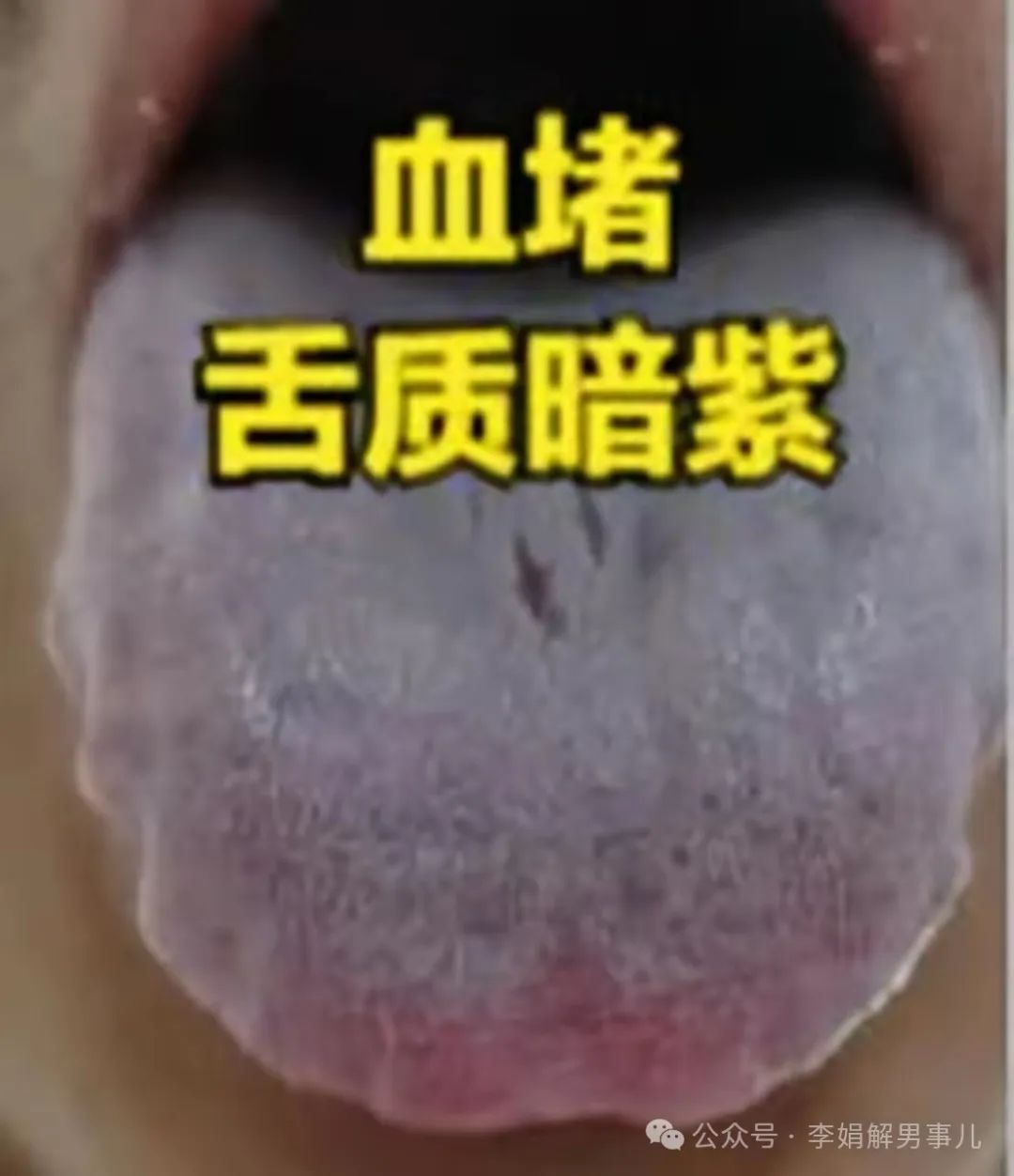 Three Tongue Manifestations Men Fear Most: Liver Qi Stagnation, Blood Stasis, and Phlegm-Dampness!
