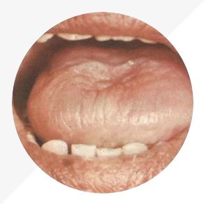 Understanding Tongue Diagnosis in TCM: Insights into Health from Tongue Appearance (Part 2)