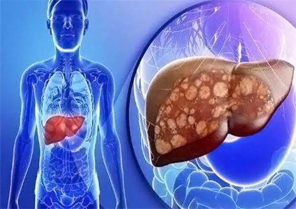 What Causes Liver Fire and Liver Qi Stagnation? Here Are 3 Key Reasons and 4 Habits to Nourish the Liver