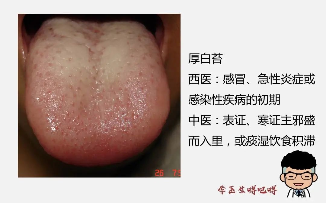 What Level of Tongue Diagnosis Does Western Medicine Have? Part 2: Tongue Quality and Coating