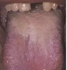 Understanding Tongue Diagnosis in Traditional Chinese Medicine (with Tongue Diagnosis Illustrations)