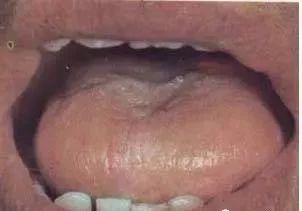 Understanding Tongue Diagnosis in Traditional Chinese Medicine (with Tongue Diagnosis Illustrations)