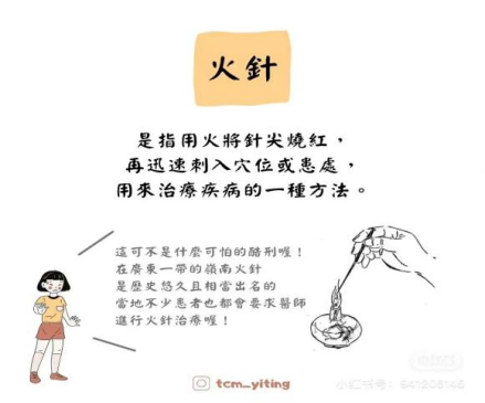 Fire Needle Therapy: A Unique Tool of Traditional Chinese Medicine