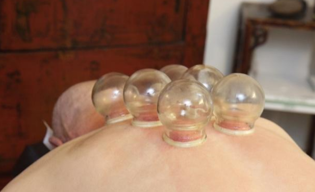 The Therapeutic Use of Cupping in Traditional Chinese Medicine: Promoting Qi and Blood Circulation, Strengthening the Body and Expelling Pathogens