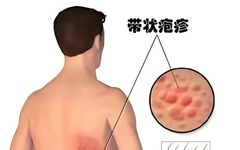 Exploring 'Fire Needle' as a Traditional Chinese Medicine Treatment for Herpes Zoster