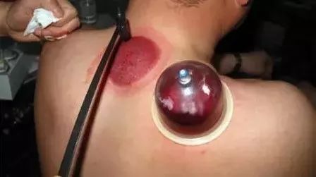 The Remarkable Practice of Bloodletting in Traditional Chinese Medicine