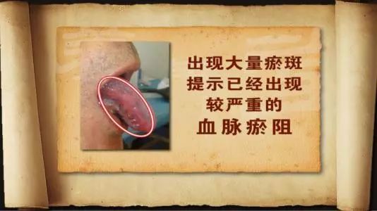 Blood Stasis Syndrome