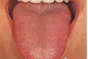 Understanding Tongue Diagnosis in Traditional Chinese Medicine (with Tongue Diagnosis Illustrations)