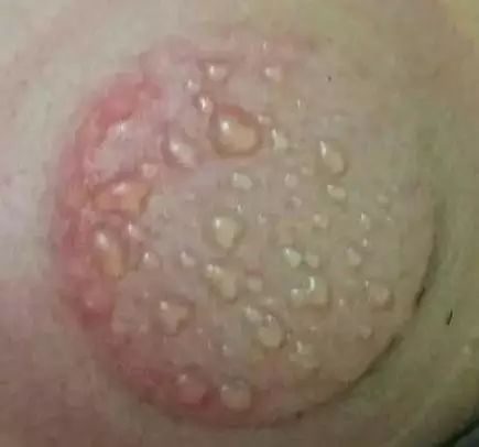 What Do Cupping Marks Indicate After Treatment?