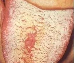 Understanding Tongue Diagnosis in Traditional Chinese Medicine (with Tongue Diagnosis Illustrations)